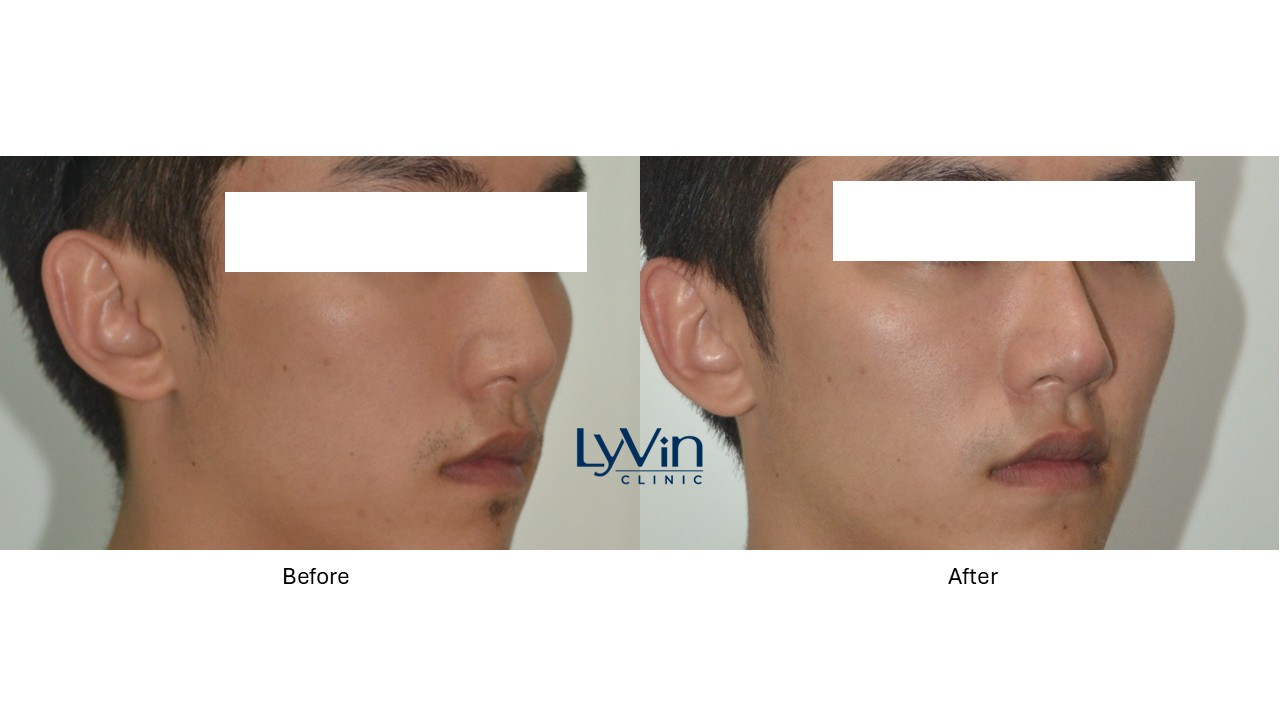 Before and after photo showing visible treatment results