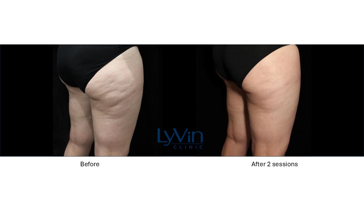 X-Wave before and after photo showing visible cellulite reduction and smoother skin.