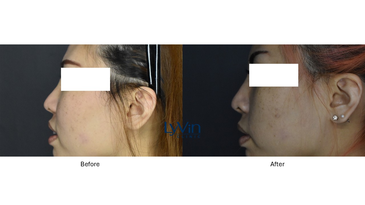 Before and after photo showing lifted bridge