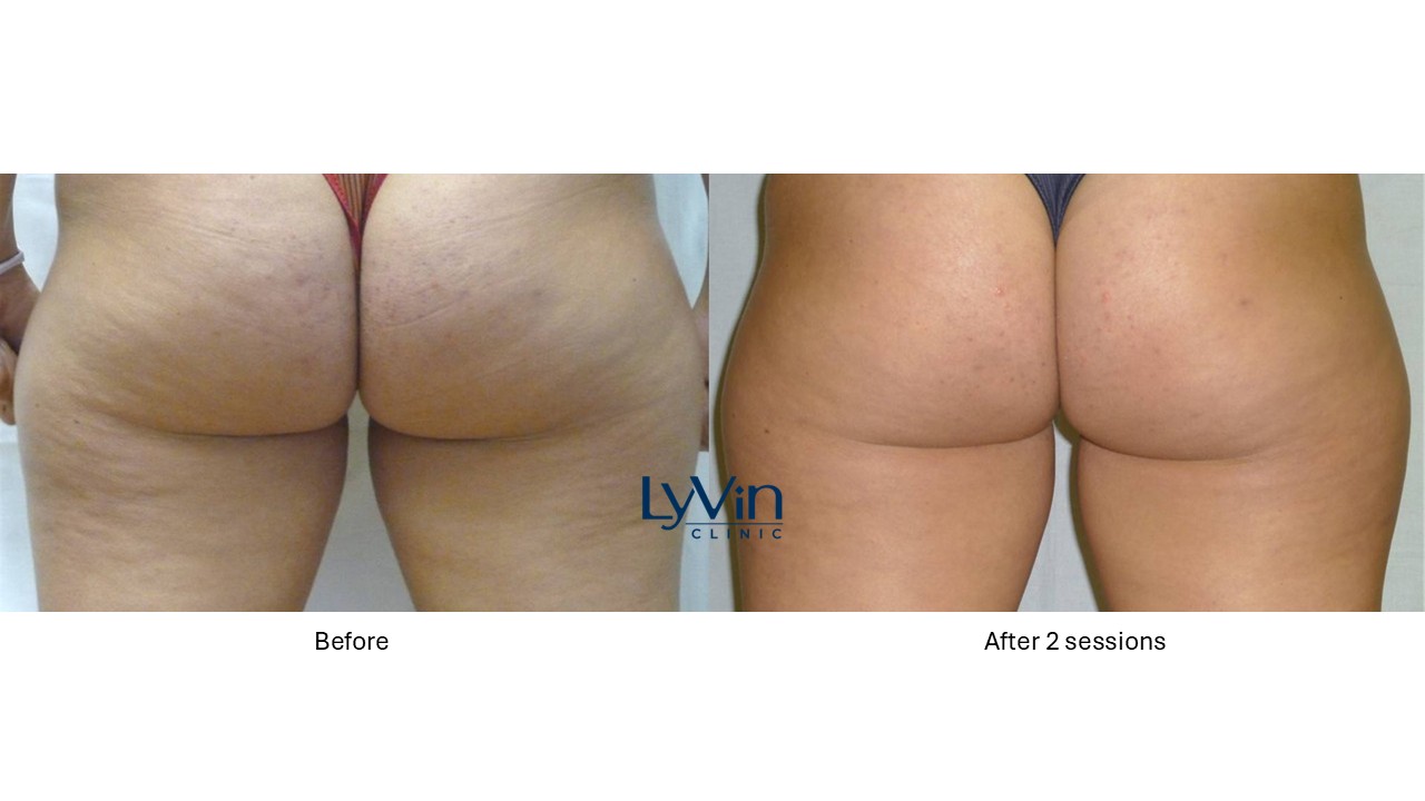 X-Wave before and after photo showing visible cellulite reduction and smoother skin.