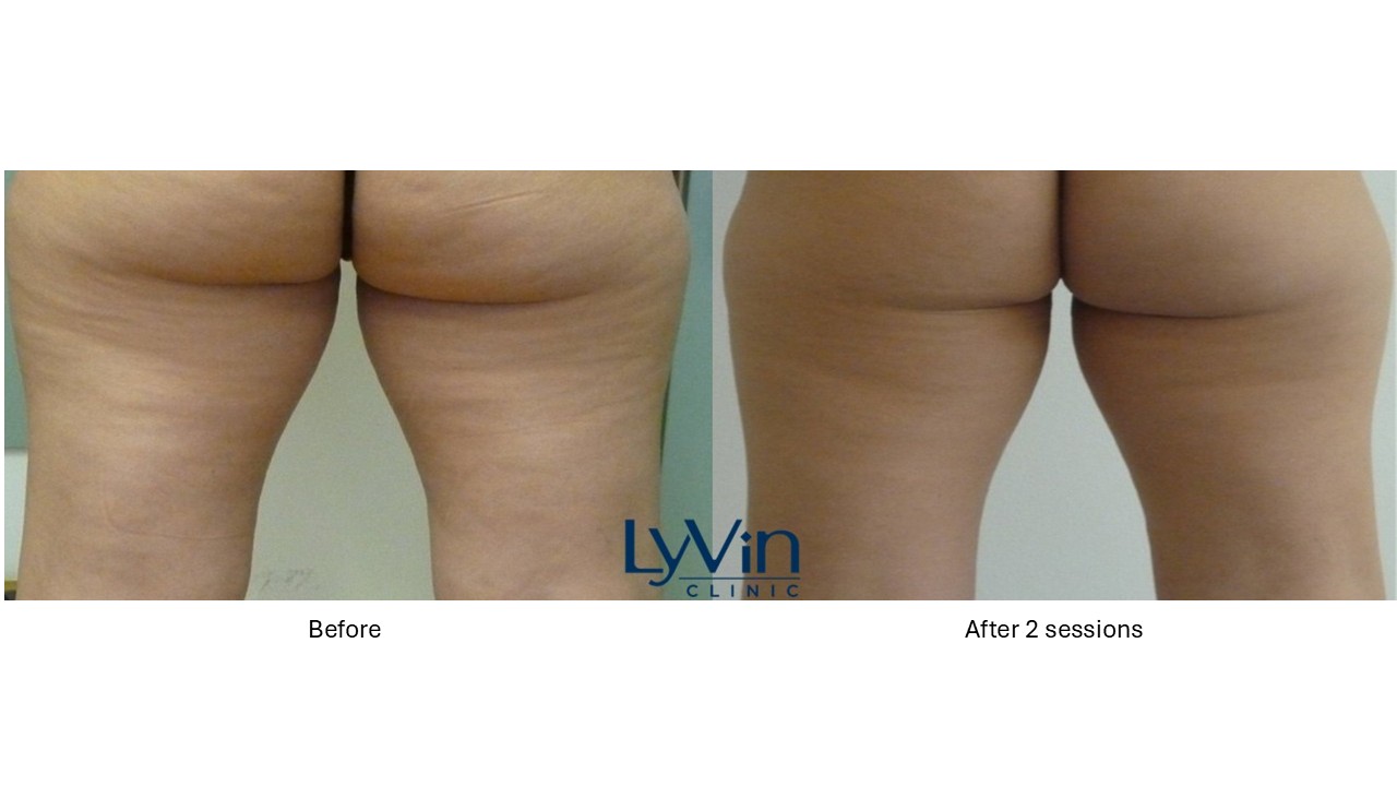 X-Wave before and after photo showing visible cellulite reduction and smoother skin.