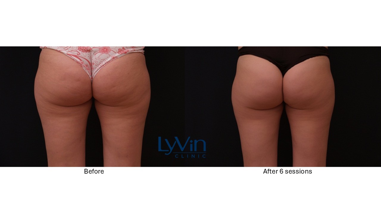 X-Wave before and after photo showing visible cellulite reduction and smoother skin.
