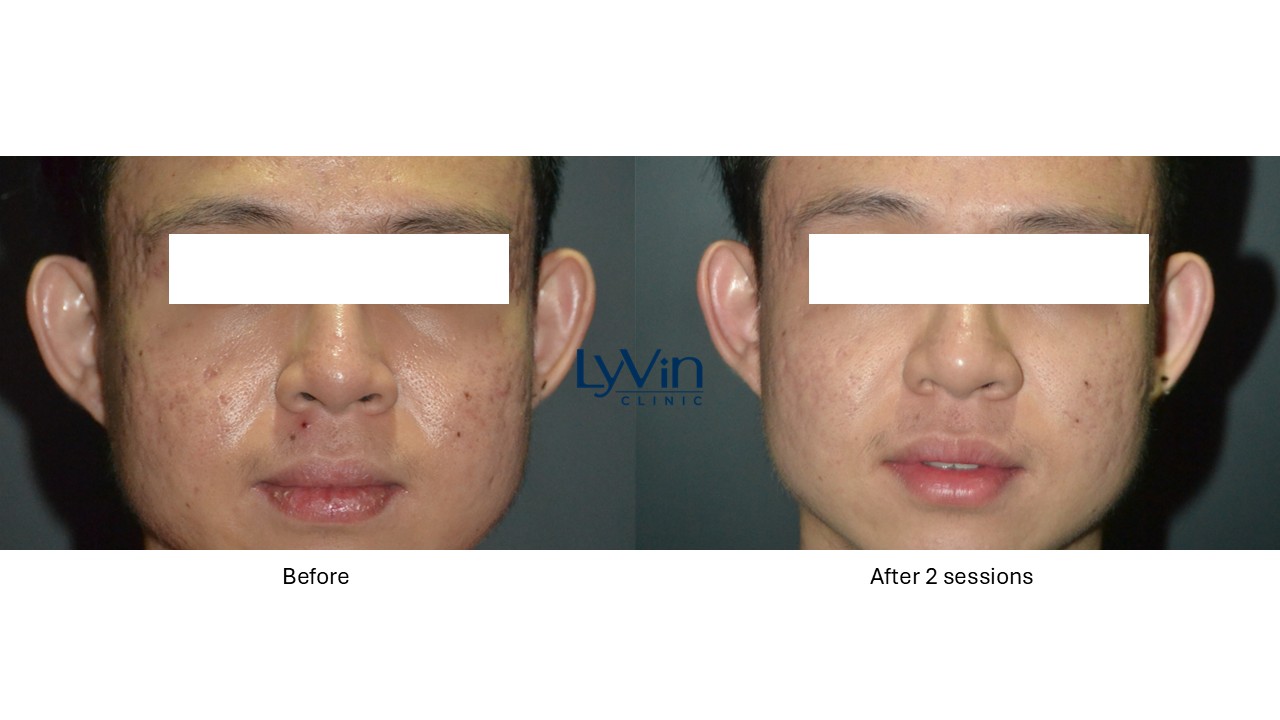 ECO2 Laser before and after photo showing acne scar improvement ECO2 Laser before and after photo showing acne scar improvement