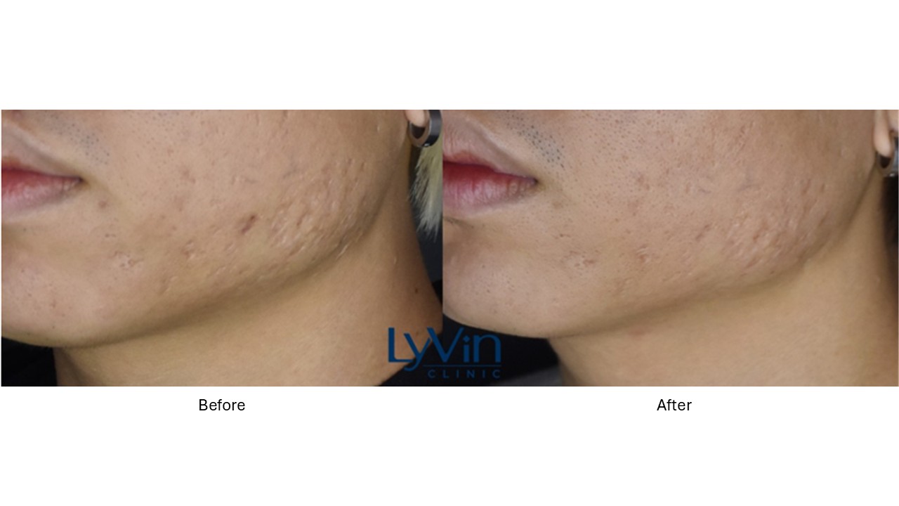 Juvelook before and after photo showing collagen stimulation results