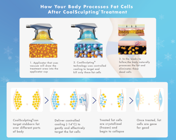 What Is CoolSculpting®?