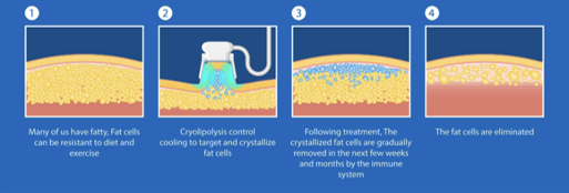 Cristal Pro® | CoolSculpting® | Fat Freezing JB | Aesthetic Clinic JB