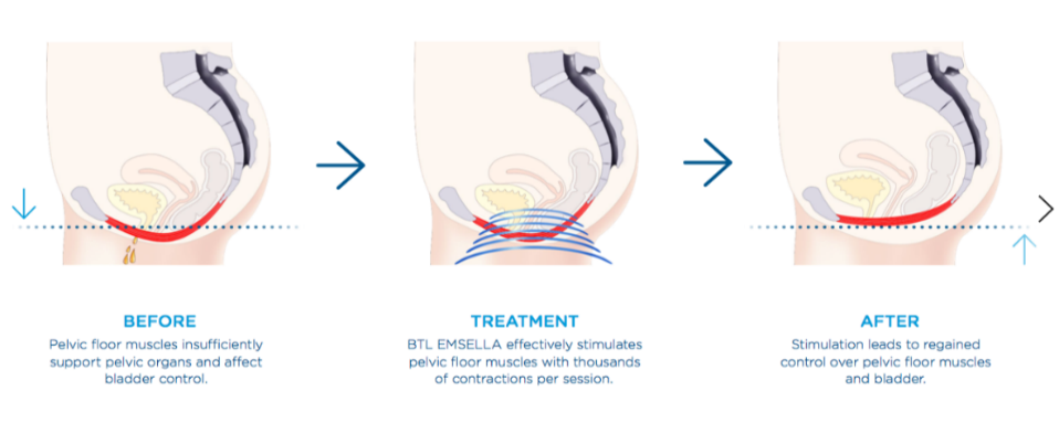 Emsella Treatment for Urinary Leakage in Johor Bahru | Strengthens Pelvic Floor to Improve Bladder Control