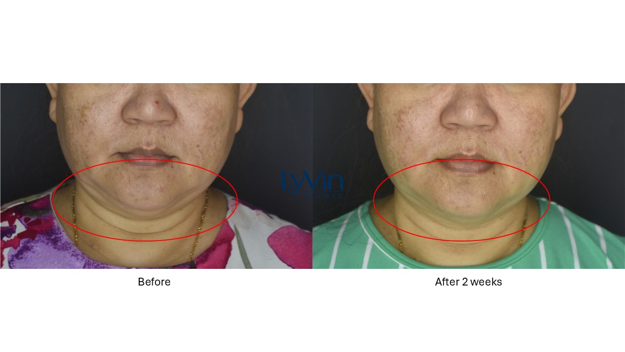 Face lifting results with Ultherapy Prime treatment – before and after comparison