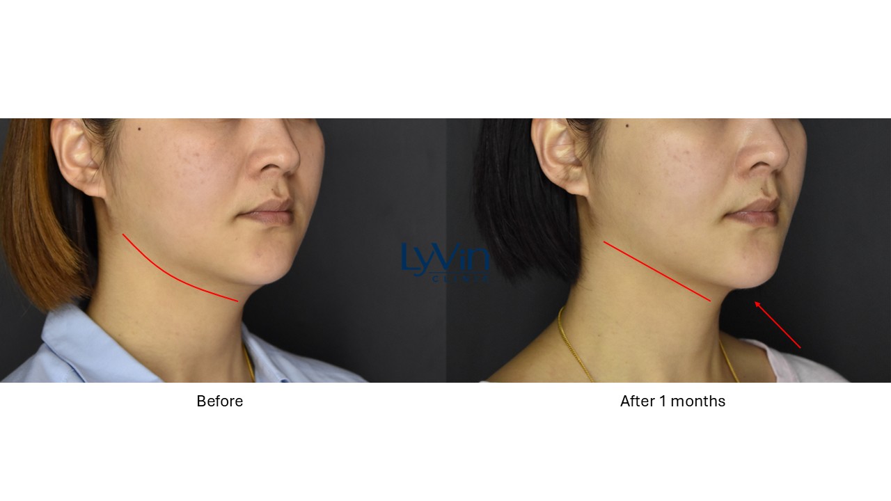 Face lifting results with Ultherapy Prime treatment – before and after comparison