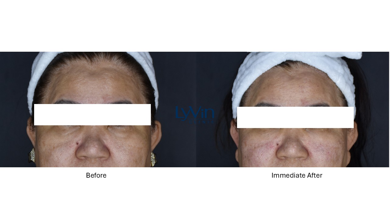 Under eye rejuvenation results with Deusaderm treatment – before and after