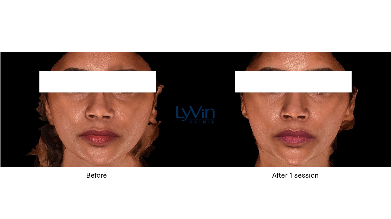 Under eye rejuvenation results with Hyalual Electri treatment – before and after
