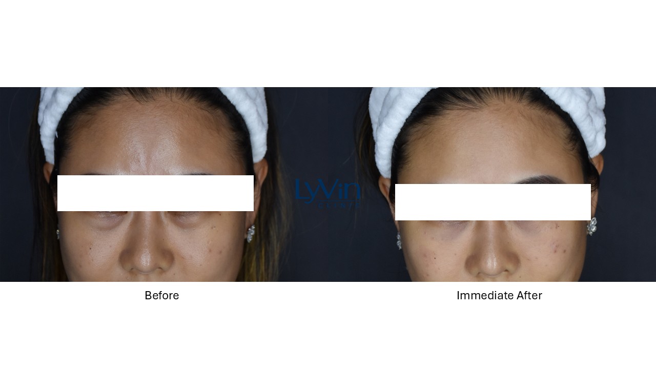 Under eye rejuvenation results with Deusaderm treatment – before and after