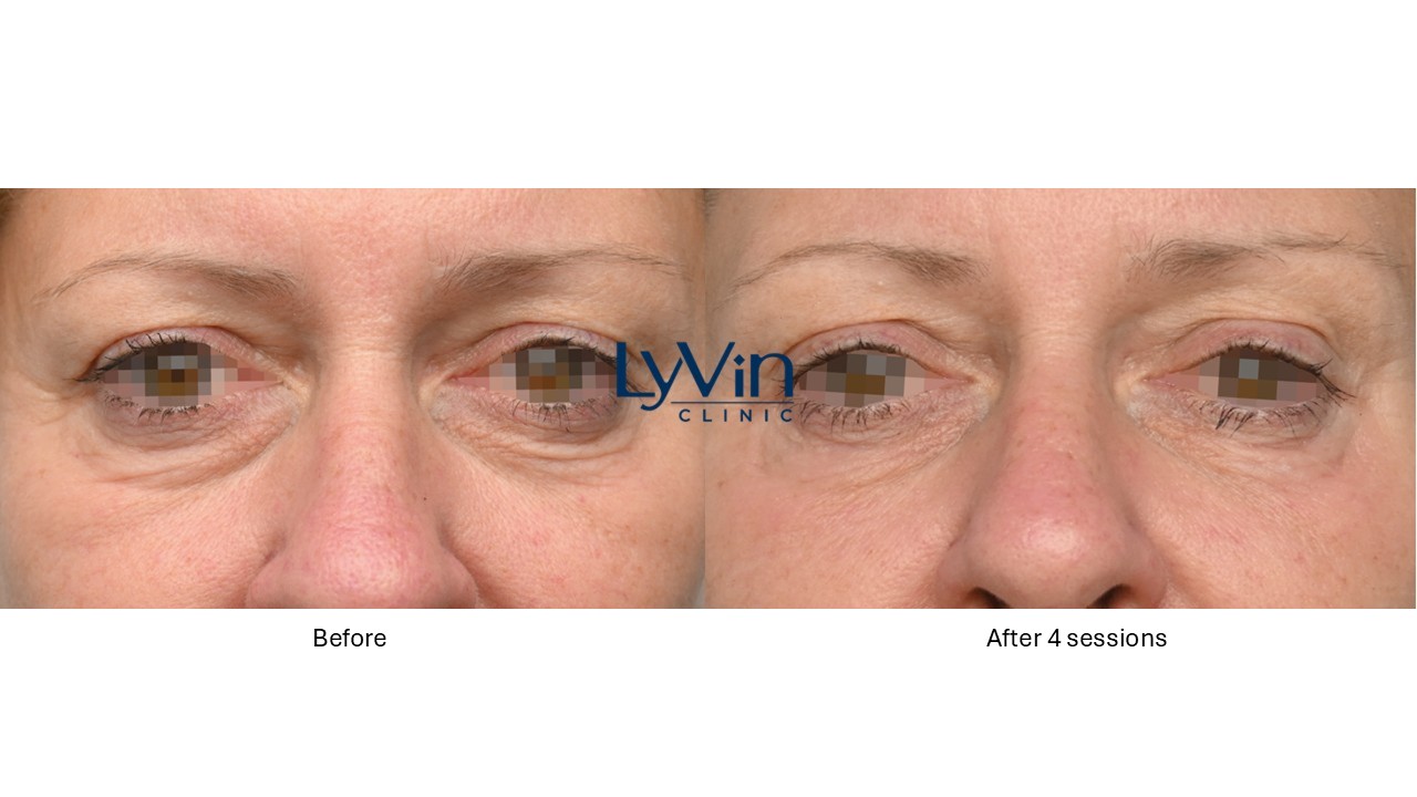 Under eye rejuvenation results with Emface Eye treatment – before and after