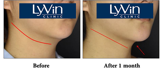 What is Ultherapy Prime? What is Ultherapy Prime?