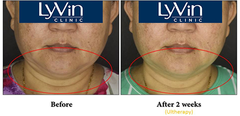 Who is a Good Candidate for Ultherapy Prime? Who is a Good Candidate for Ultherapy Prime?