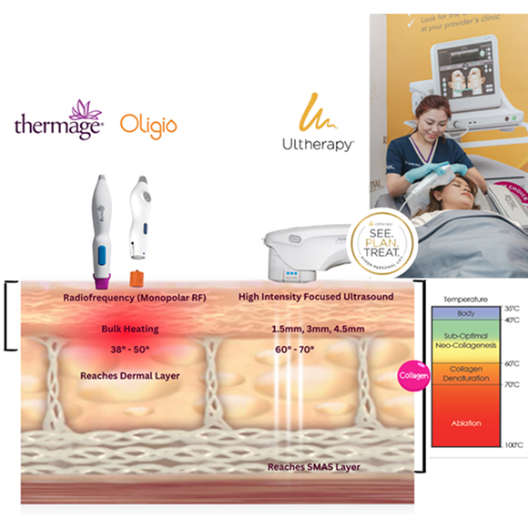 Unlike other HIFU, Ultherapy Prime: Unlike other HIFU, Ultherapy Prime: