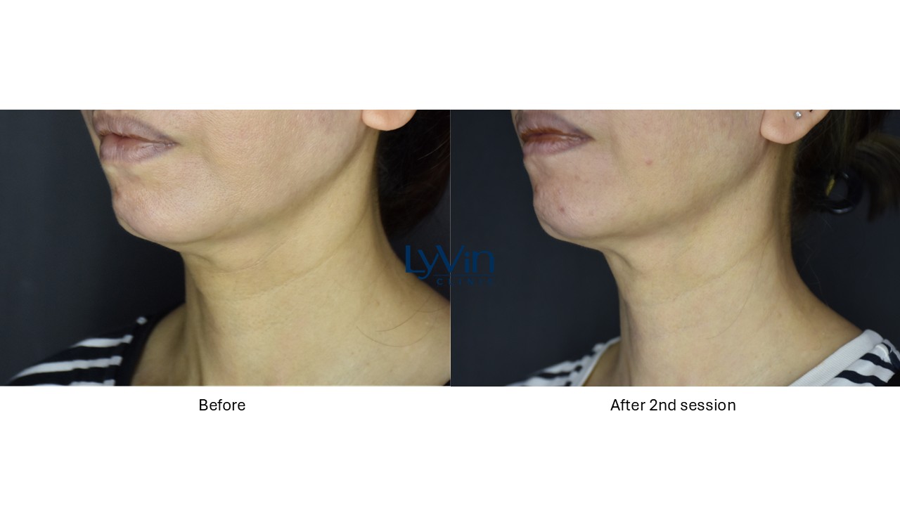 Profhilo treatment comparison photo – improved elasticity and fine line reduction