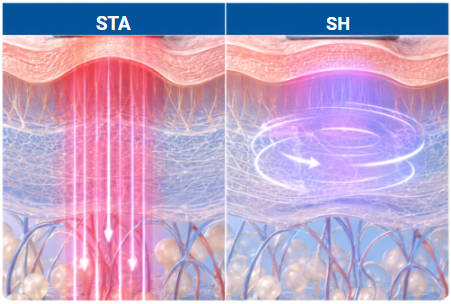 STA and SH Modes in Titanium Lifting Treatment | Lyvin Clinic JB